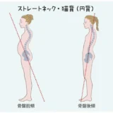 ストレートネック