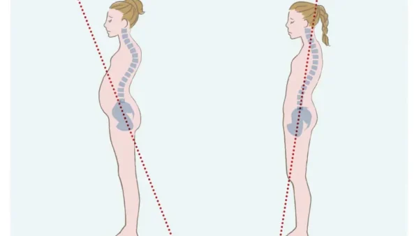 ストレートネック